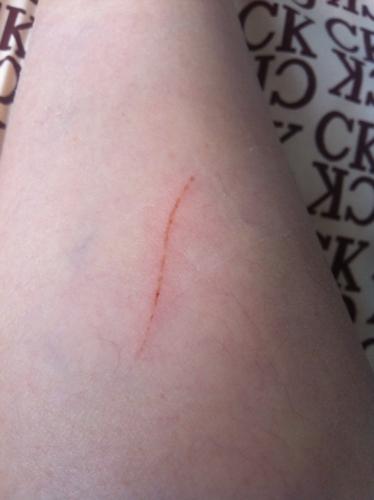 伤口处比第一天宽了,  不小心被我家的小狗用爪子抓伤,一条淋子,出血