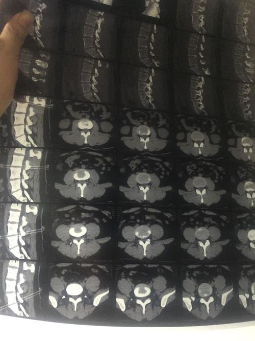 请问腰间盘突出怎么办?这是片子