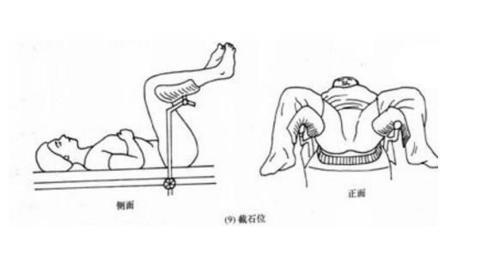 (截石位示意图) "平时我们想让他坐在轮椅上,都得拿木棍猛击,关节才能