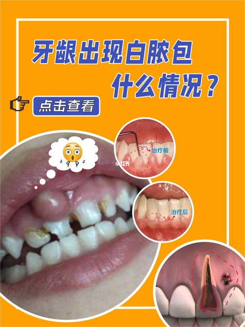 牙龈出现白脓包什么情况