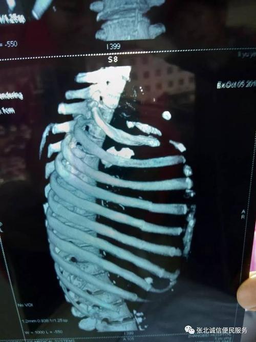 【视频】张北县台路沟乡老太太被打送进医院,4-8根肋骨骨折,右侧胸腔