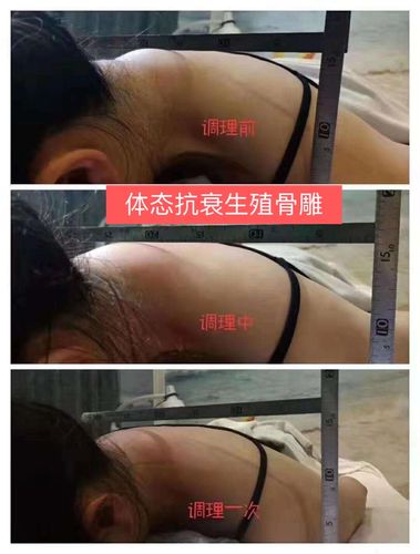 体态抗衰生殖骨雕介绍