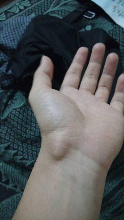 左手手腕长了一个硬疙瘩,去医院看医生,医生说两种方法,一个切掉,但要