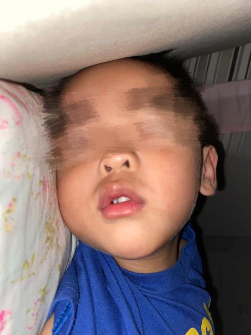 宝宝 腺样体面容了?_腺样体_腺样体肥大_母婴_育儿经验