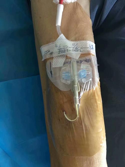 picc ——经外周置入中心静脉导管