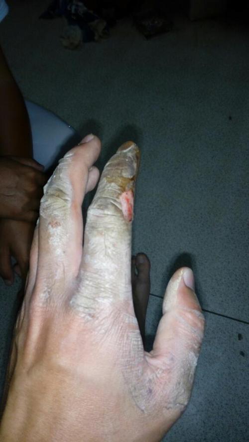 手被电击伤多久能好