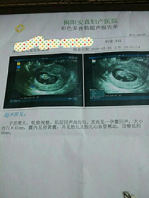 怀孕11周 4做的b超帮忙看看是男孩还是女孩谢谢啦