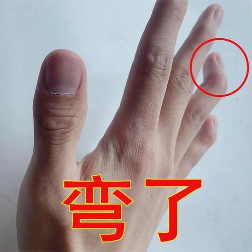 弯了→戴套→直了:手指肌腱断裂还可以这样自愈