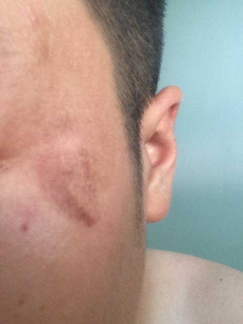 摸风油精脸上皮肤变黑能以后怎么办