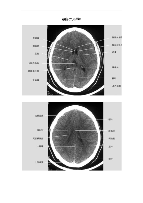 颅脑ct片详解.doc