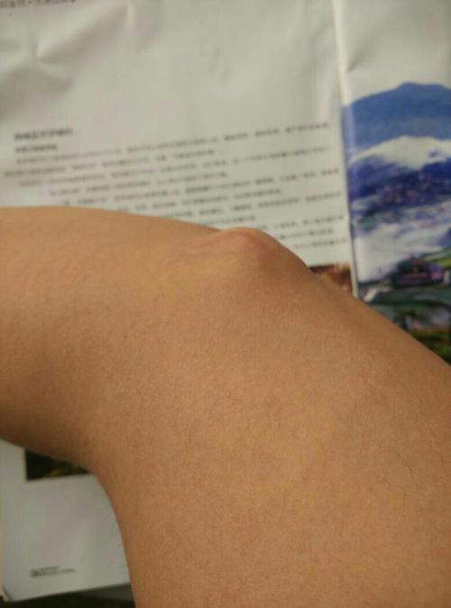 肘部腱鞘囊肿,活动量大时有轻微压迫感,胀痛感,以前做
