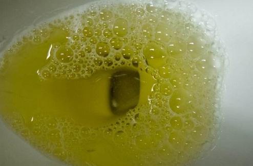 为什么尿液发黄怎么办为什么尿液很黄很浑浊