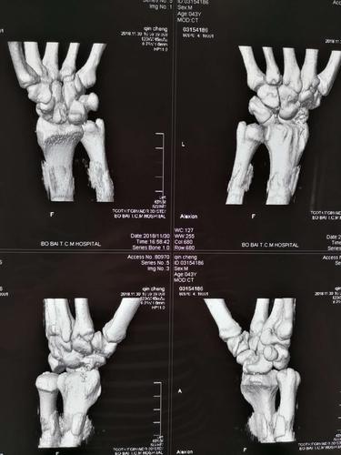 术前三维重建ct