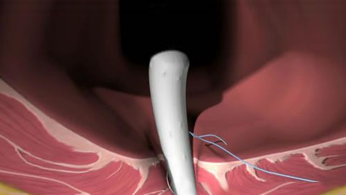 肛瘘的挂线手术怎么做?