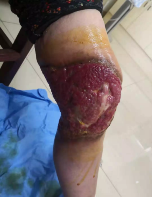 锦旗赠仁医,七旬患者膝部大面积皮肤溃烂,佛山正骨医院精心治疗除顽疾