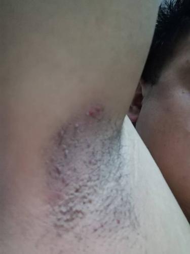 腋下长肉疙瘩,还痛谁知道是什么