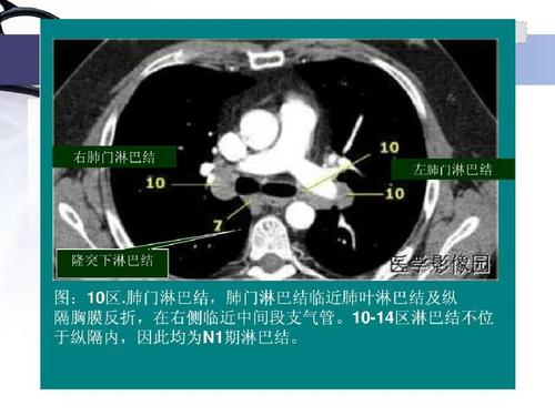 goo l 上一页第8页 下一页 你可能喜欢 淋巴结肿大 纵隔淋巴结分区