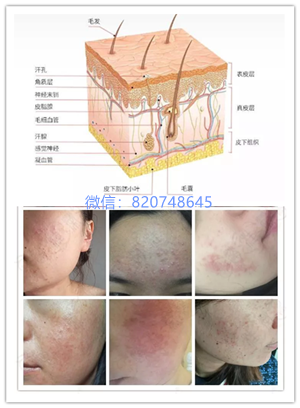 皮肤科专家揭秘激素脸治疗的排毒反应!