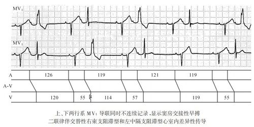 【图】窦性二联律的类型及心电图特征