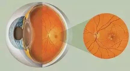 我的眼睛里长了黄斑,需要治疗吗?