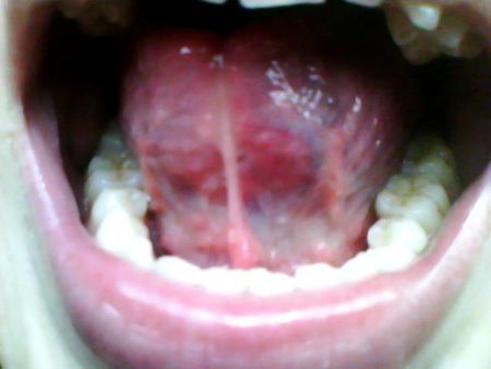 舌头肥大,舌头根部长了很多小肉疙瘩.说话有点硬.有大半年了.