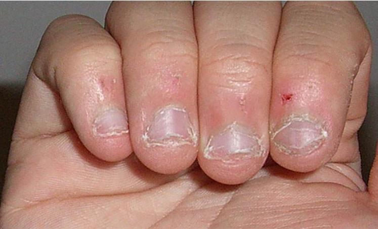 【爱咬指甲爱吃手】找对办法才是关键,走出心中的阴霾,不在咬甲!