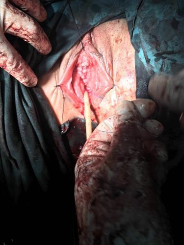 榆林一院病例分享-子宫脱垂行阴式全子宫切除术 阴道残端骶棘韧带悬吊