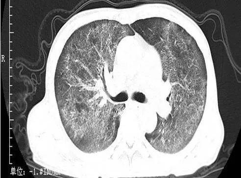 多发生于免疫功能缺陷患者,如急性白血病,慢性消耗性疾病,恶性肿瘤