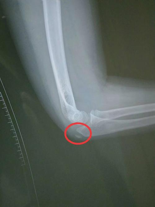 请问大家,这张片子出,是骨折了吗?