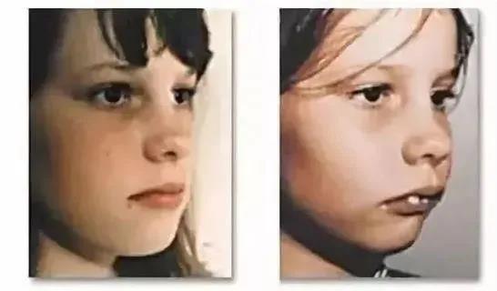 上牙弓窄,牙齿前凸,龅牙,鼻子扁平,嘴唇没办法包住牙齿等"口呼吸面容"