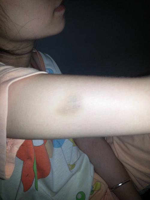 问:右手臂出现一块一元硬币大小的淤青,按压不疼,要用力按才有点痛.