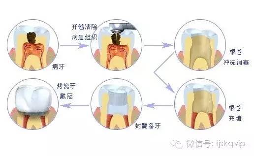 【口腔微学院】为什么补牙后需要带牙套?