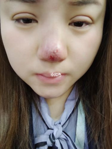 鼻子打玻尿酸栓塞 退加赔6500多吗_玻尿酸_整容_黑发_发炎_消炎_美妆