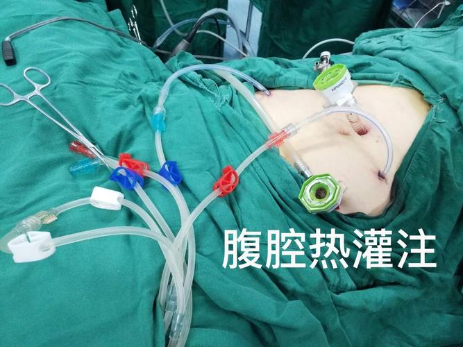 医院妇科首例腹腔镜下卵巢癌肿瘤细胞减灭术 腹腔热灌注化疗成功开展