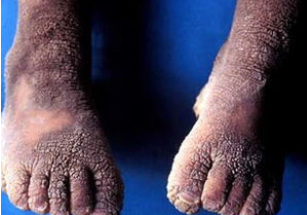 得了鱼鳞病能活多久