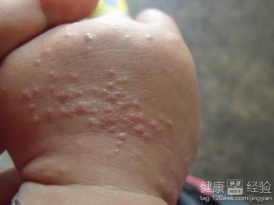 异位性皮炎多数是遗传导致的嘛