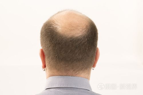 过早秃顶男人,40 多岁,白色背景