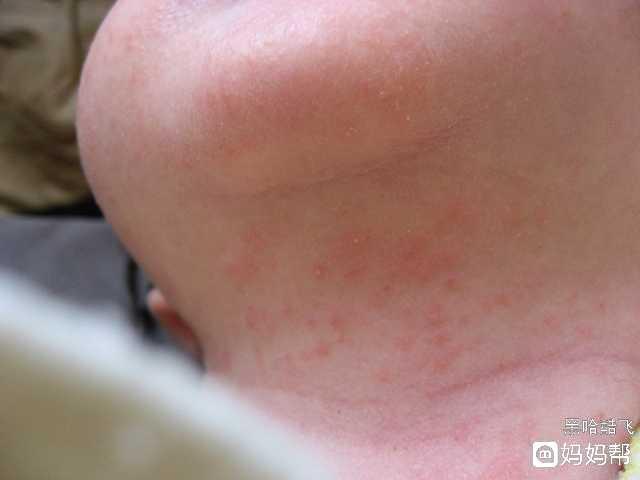 猜你喜欢* #新生儿护理我有招#          婴儿湿疹,也叫"胎毒","奶癣"