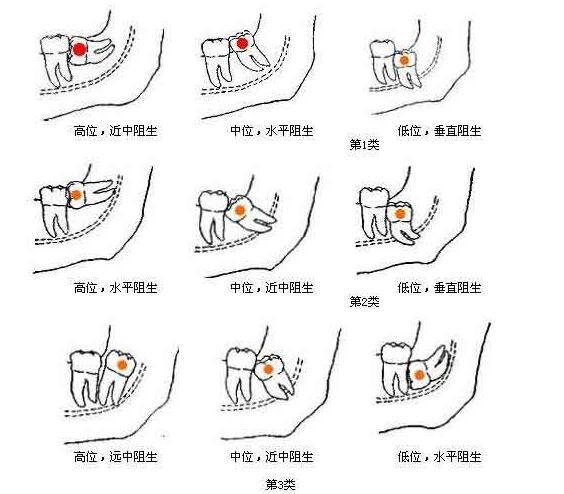 拔智齿瘦脸的传说 原来给你这么多错觉!