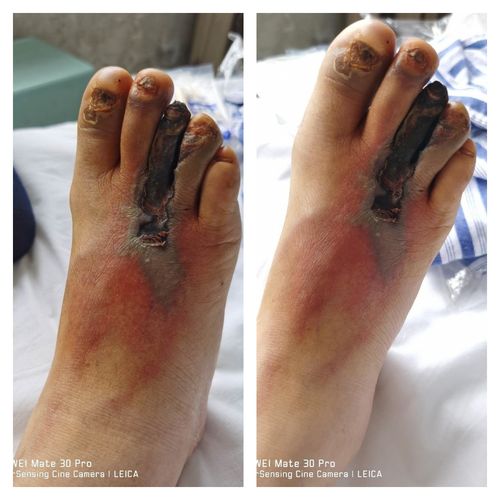 下肢动脉硬化闭塞症mdt