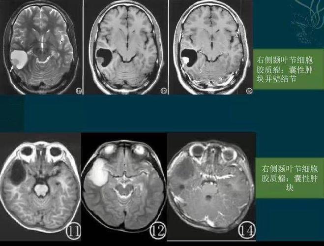 二,影像表现:右颞叶海马区占位性病变,ct呈略高密度,t1wi呈低信号