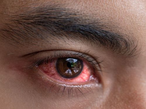 眼睛充血怎么办