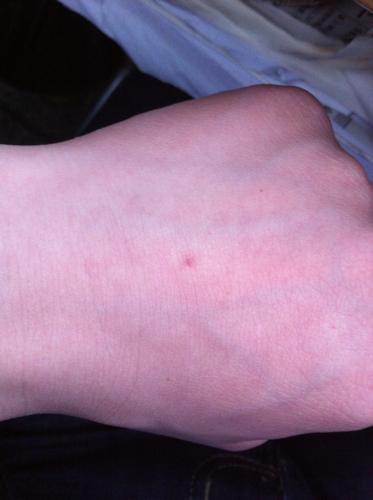 和正常皮肤一样 评论|  2014-04-23 11:04 |来自|四级 毛细血管瘤,没