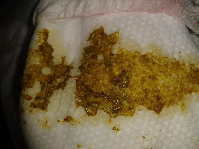 一般来说,引起婴幼儿急性腹泻的最常见原因就是感染了轮状病毒.