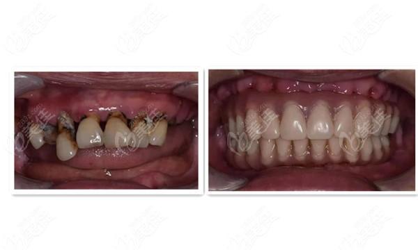 沈阳欢乐口腔李江明博士全口种植牙技术是真可以,即刻