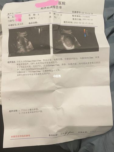 卵巢巧克力囊肿微创手术_巧克力_性生活_婚姻_护士_巧克力囊肿_医疗