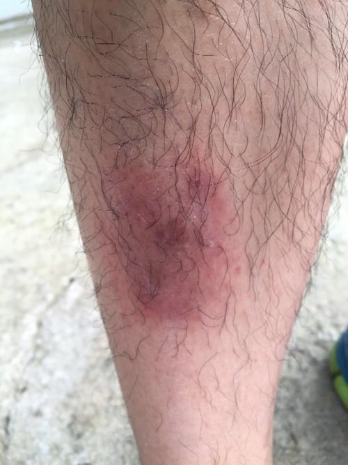 右小腿疼痒,这是过敏还是皮炎?感觉一段时间会疼痒一下