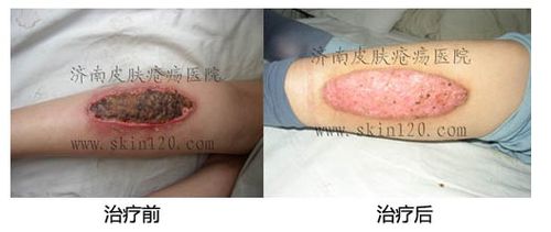 体:左小腿后侧可见15×5cm烫伤创面,上覆褐色干痂,周围皮肤红肿