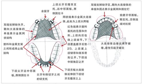 【口腔进修医师常见问题】可摘局部义齿支架设计