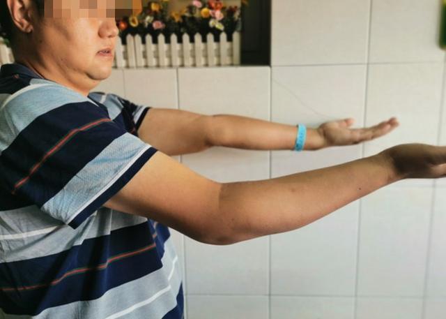 肘关节异位骨化切除帮他在8年后恢复双手"灵巧